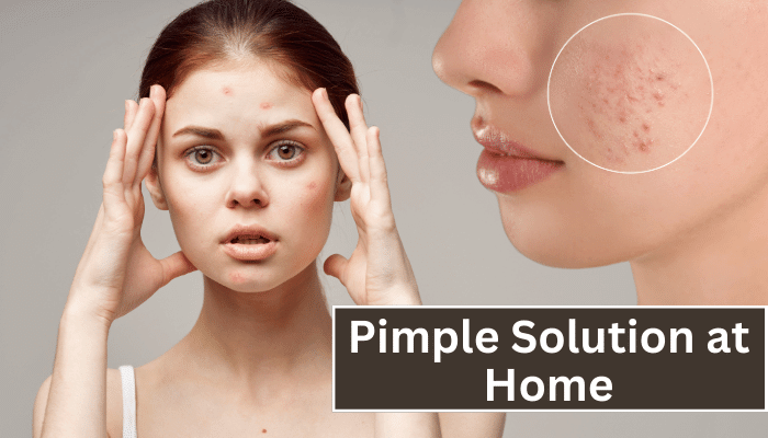 Pimple Solution at Home - कील मुहांसों का घरेलू इलाज